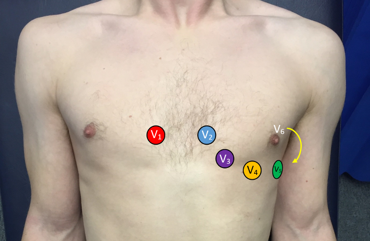 Image of a chest which demonstrates the correct placement of ECG leads.