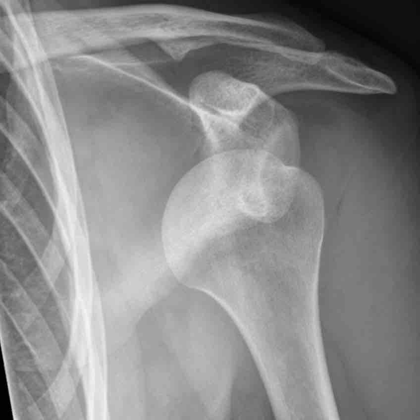 Dislocated shoulder X-ray 10