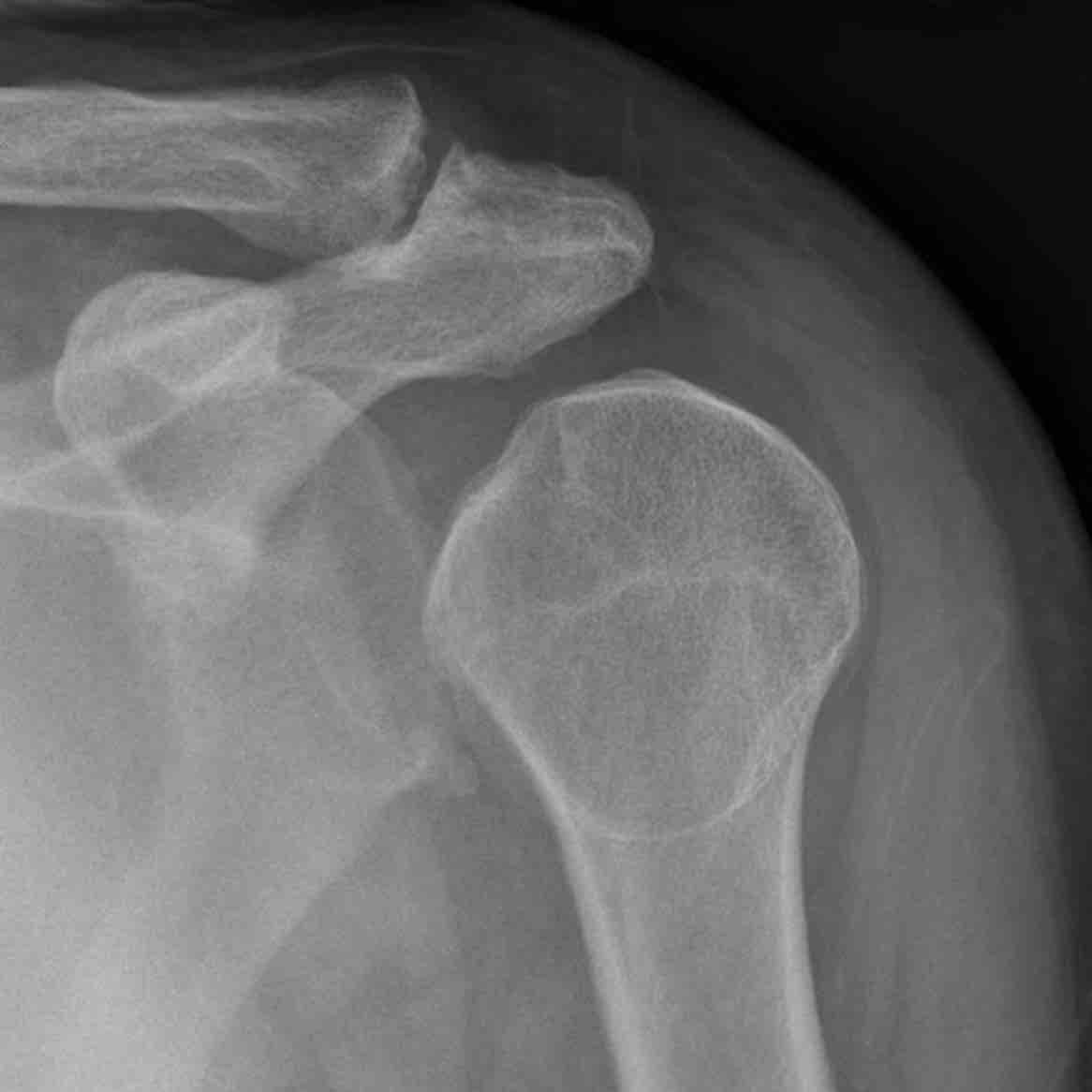 Lightbulb sign - posterior shoulder dislocation - Roe vor und nach Reposition 001
